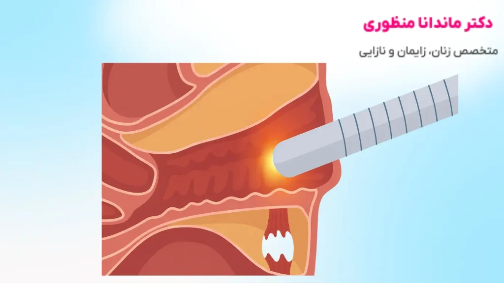 عوارض آر اف واژینال
