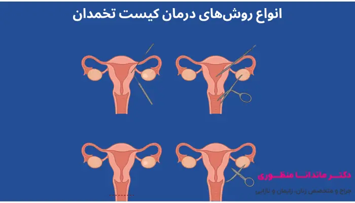 انواع روشهای درمان کیست تخمدان