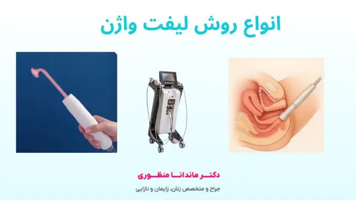 انواع روش لیفت واژن
