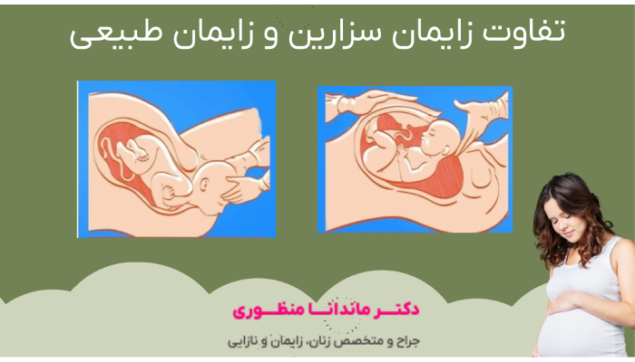 تفاوت زایمان سزارین و زایمان طبیعی