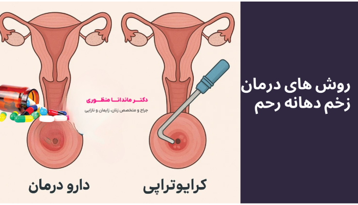 روش های درمان
زخم دهانه رحم