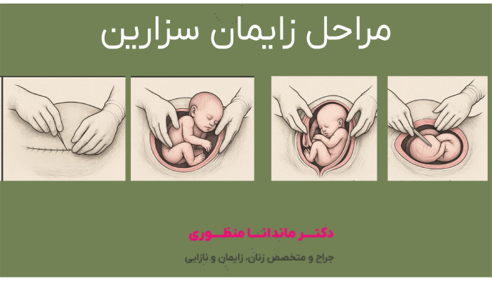 مراحل زایمان سزارین