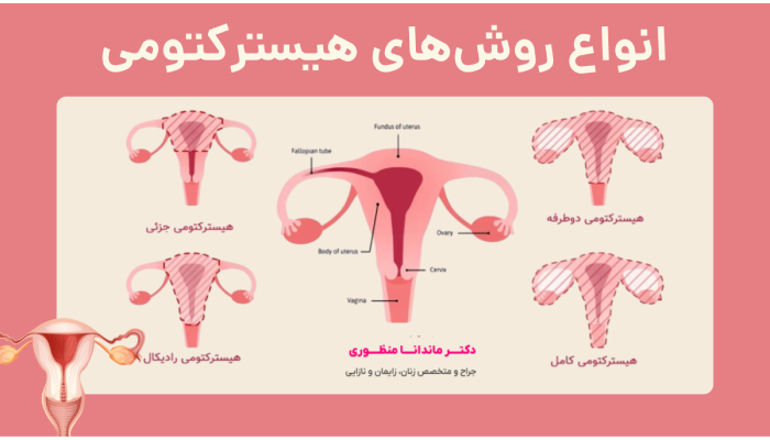 انواع روشهای هیسترکتومی