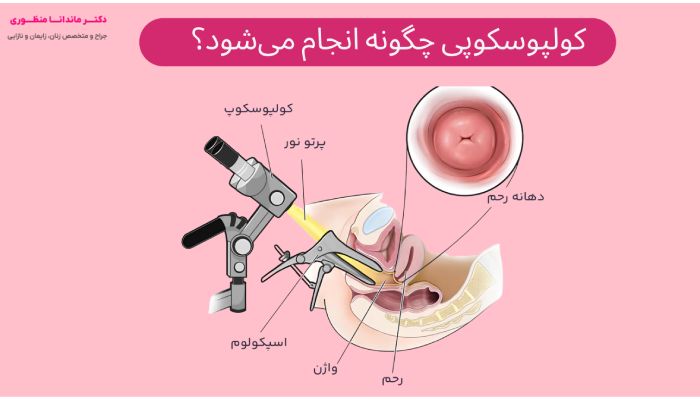 کولپوسکوپی چگونه انجام می شود؟